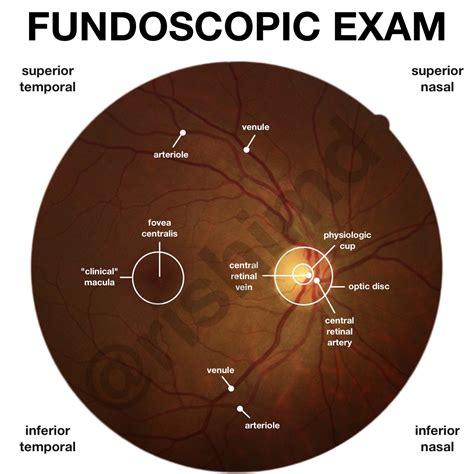 common fundoscopic exam findings.